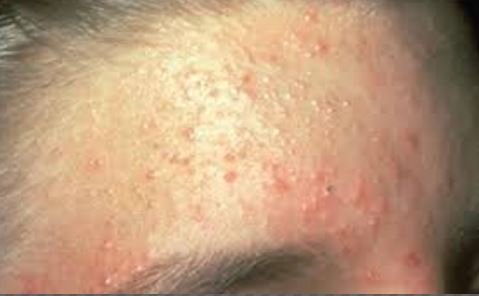 yeast infection Pimples on Face