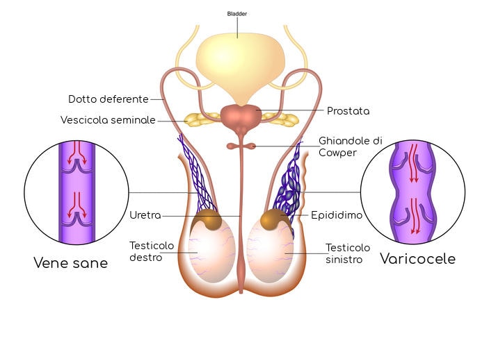 Rappresentazione schematica del varicocele