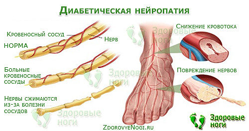 Причиной появления ранок на ногах при диабете обычно является нейропатия