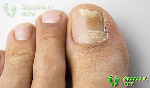 Грибковая инфекция может стать причиной почему болят пальцы ног при диабете