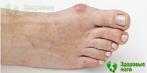 Если при диабете покраснел большой палец на ноге, то возможно это проявление вальгусной деформации