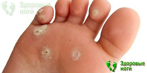 Даже такой дефект кожи, как бородавки может вызывать боли в пальцах ног при диабете