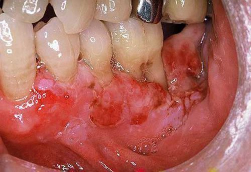 Эрозии на деснах при гингивите