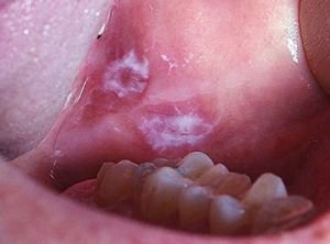 Лейкоплакия во рту - предраковое состояние