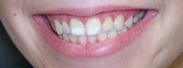 Почему появляются белые пятна на зубах и как от них избавиться?